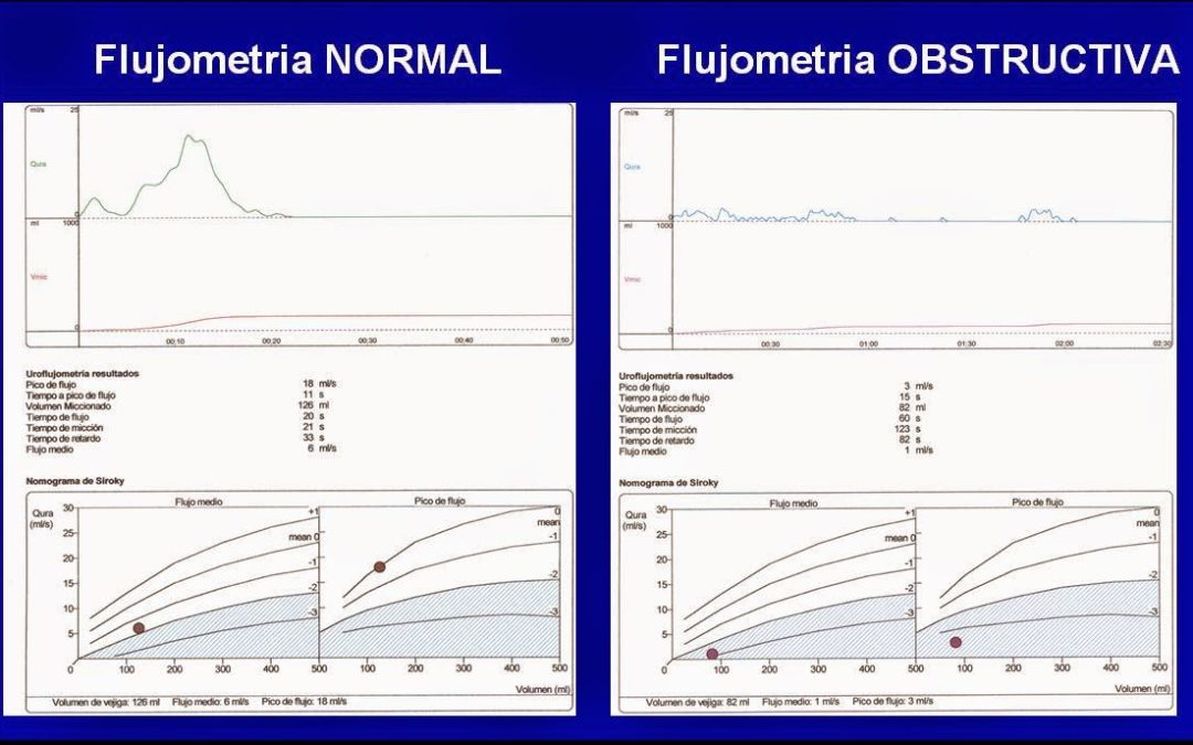 Urología: flujometrías